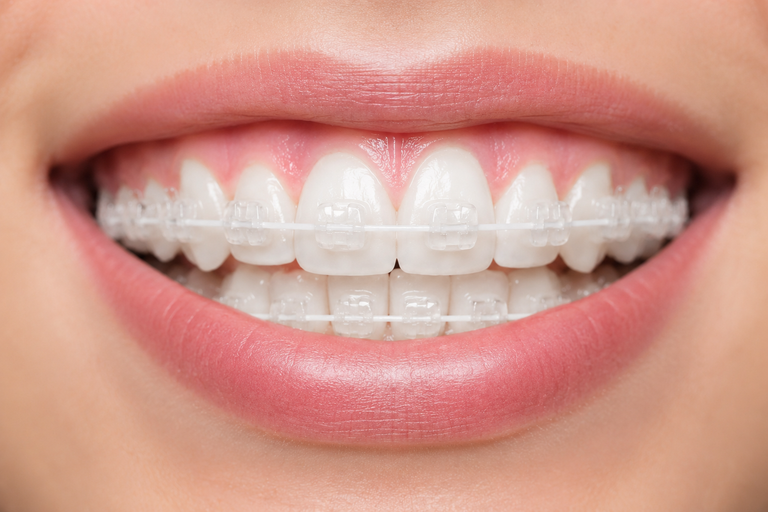 Niềng răng mắc cài sứ dây trong