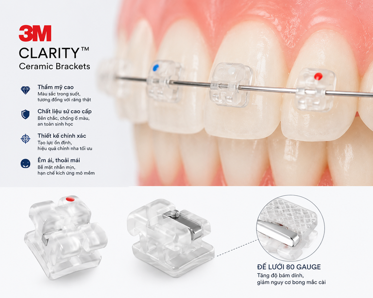 Niềng răng mắc cài sứ 3M