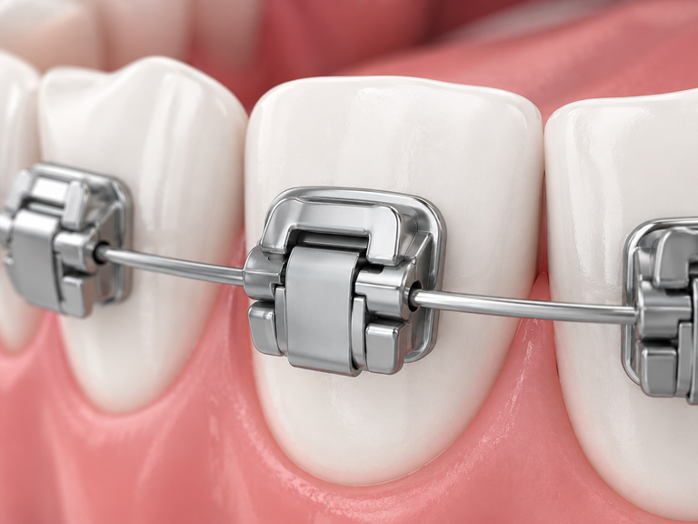 Niềng răng mắc cài tự động khóa trượt