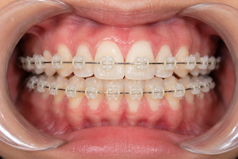 Niềng răng mắc cài sứ truyền thống sử dụng chun buộc