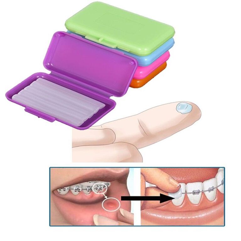 Mẹo giảm đau sau niềng răng mắc cài