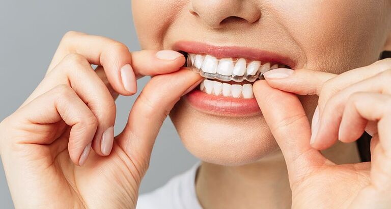 Review niềng răng không mắc cài có thật sự hiệu quả