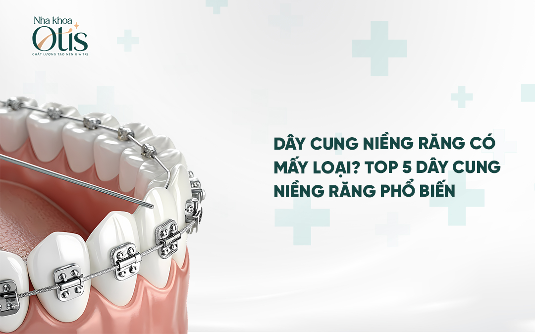 Có mấy loại dây cung niềng răng
