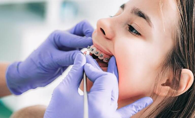 Thời gian niềng răng mắc cài ở trẻ em nhanh hơn