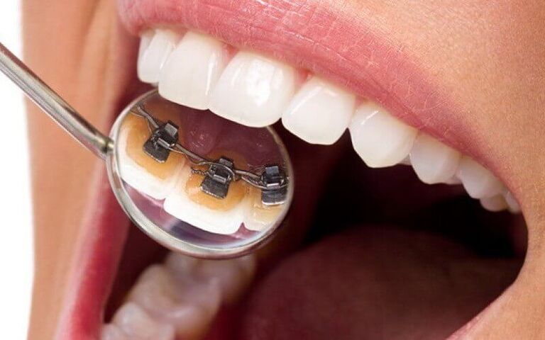 Niềng răng mắc cài mặt trong 1 hàm
