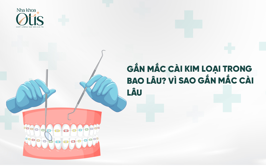 Gắn mắc cài niềng răng mất bao lâu