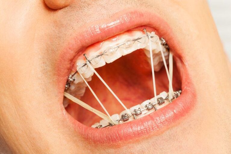 Đóng khoảng răng bằng thun liên hàm