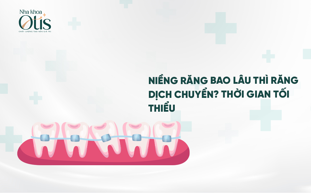 Niềng răng bao lâu thì răng dịch chuyển