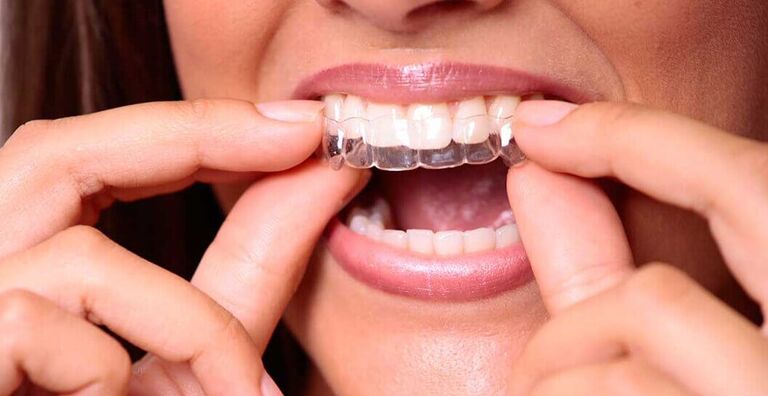 Niềng răng không mắc cài 3D Clear dễ tháo lắp