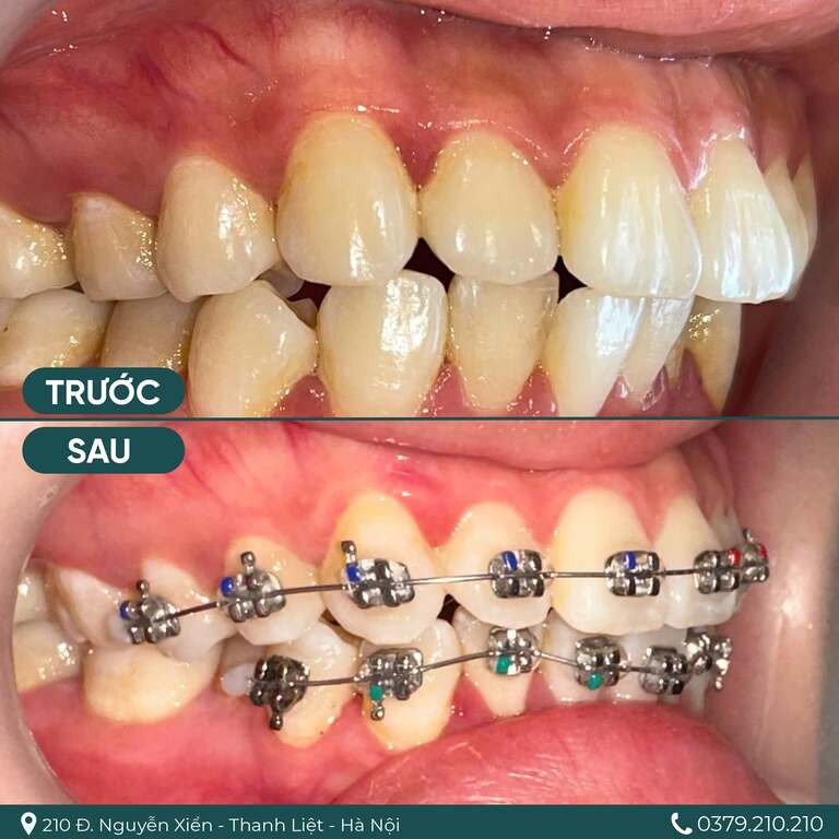 Răng chen chúc cần nong hàm khi niềng răng