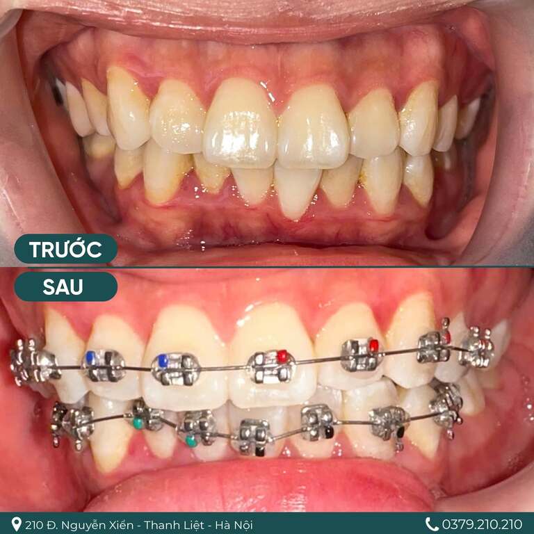 Răng hô nặng cần nhổ răng khi niềng răng để tạo khoảng trống