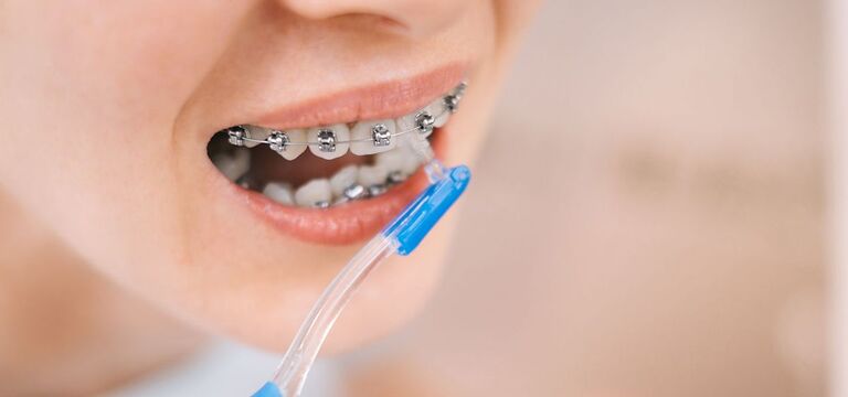Vệ sinh niềng răng mắc cài bằng tăm nước