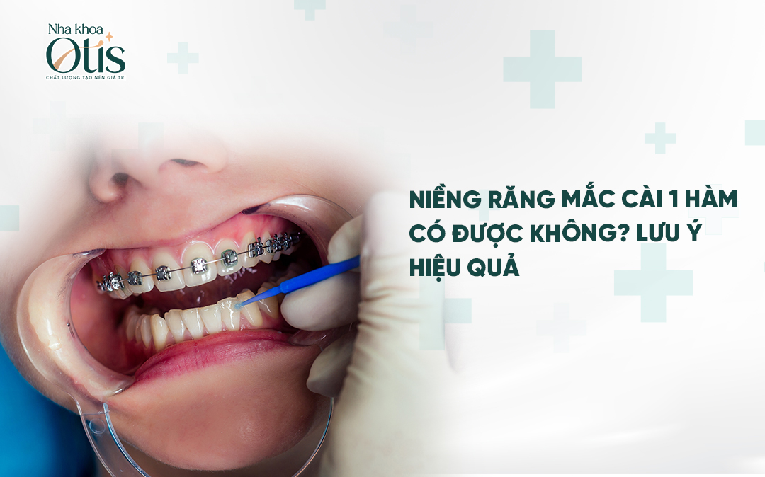 Niềng răng mắc cài 1 hàm có được không