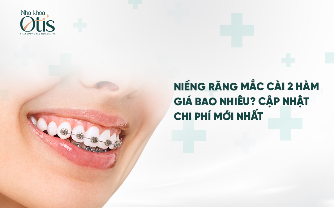Báo giá niềng răng mắc cài 2 hàm