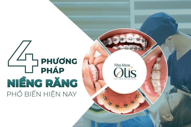 Phương pháp niềng răng hô