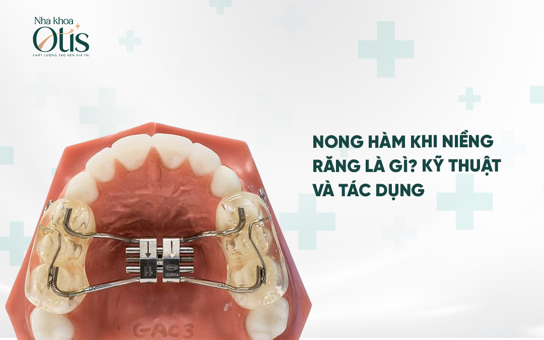 Nong hàm khi niềng răng là gì