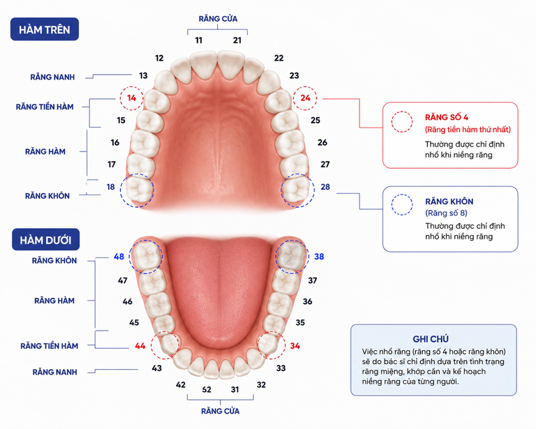 Thường chỉ định nhổ răng số 4 và răng khôn khi niềng