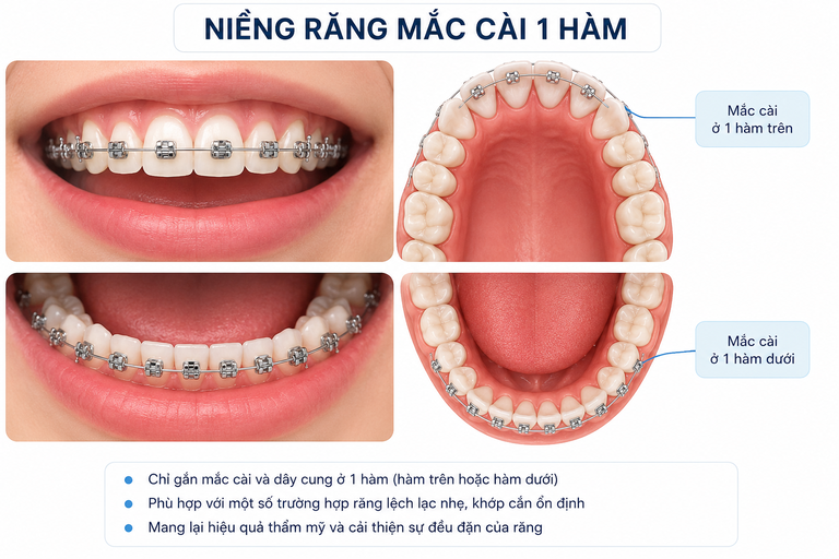 Niềng răng mắc cài 1 hàm