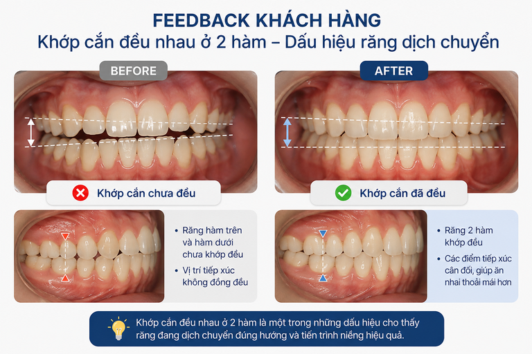 Khi cảm thấy khớp cắn đều là răng đã dịch chuyển