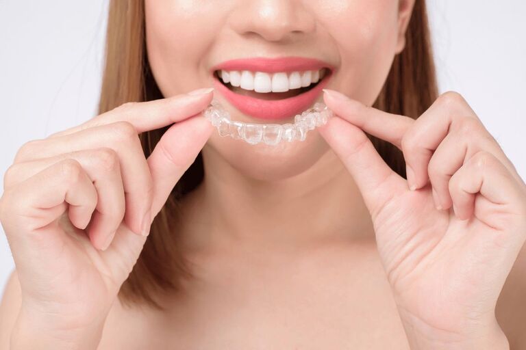 Niềng răng mắc cài sứ cần thêm thời gian đeo hàm duy trì