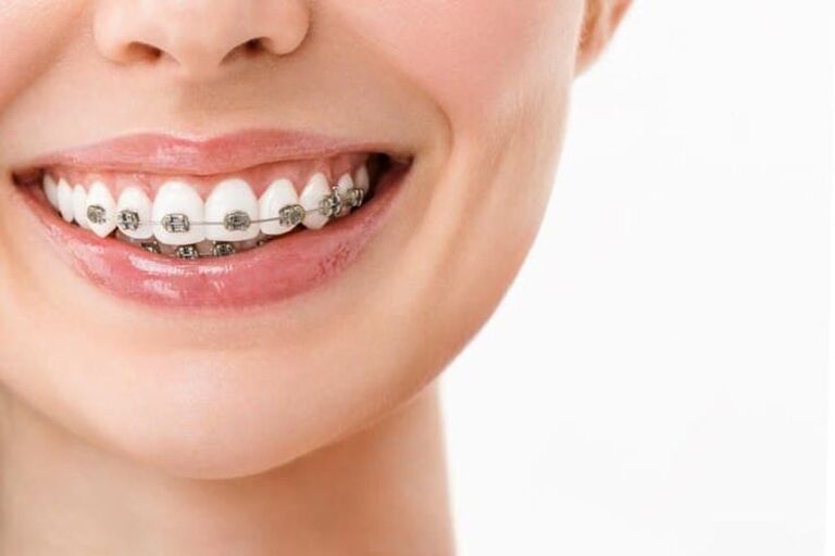 Niềng răng mắc cài 2 hàm