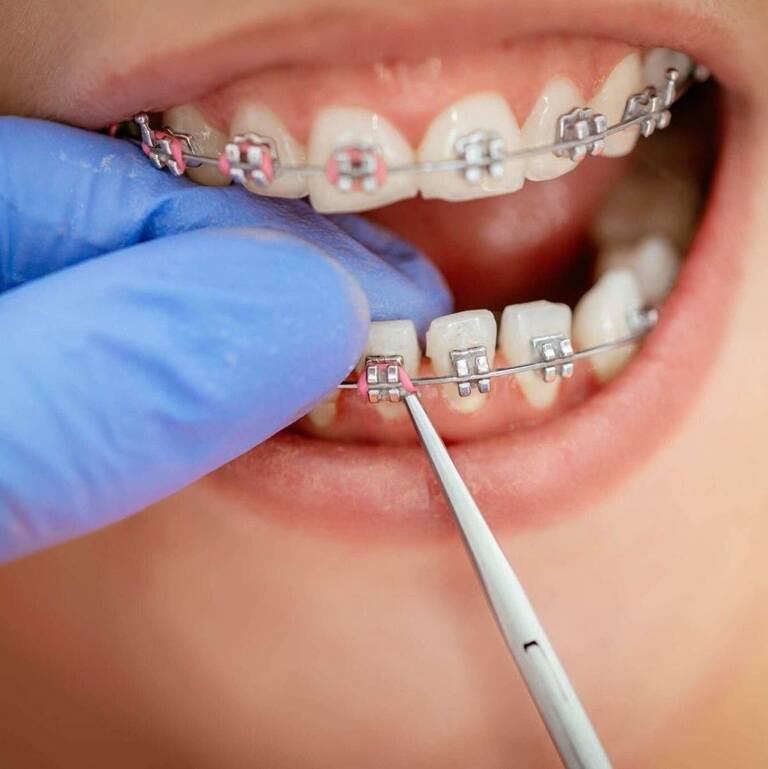 Siết răng khi niềng răng giúp dịch chuyển răng