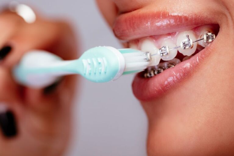 Cách vệ sinh khi niềng răng mắc cài bằng bàn chải